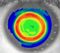 Mappa corneale post-applicazione